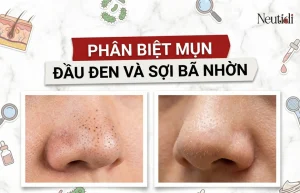 Đừng nhầm mụn đầu đen & sợi bã nhờn: cách phân biệt & xử lý đúng 23 Phân biệt mụn đầu đen và sợi bã nhờn