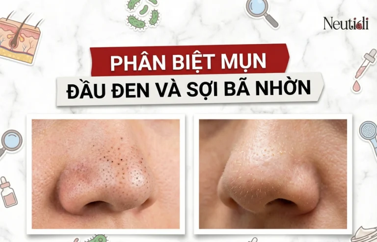 Phân biệt mụn đầu đen và sợi bã nhờn