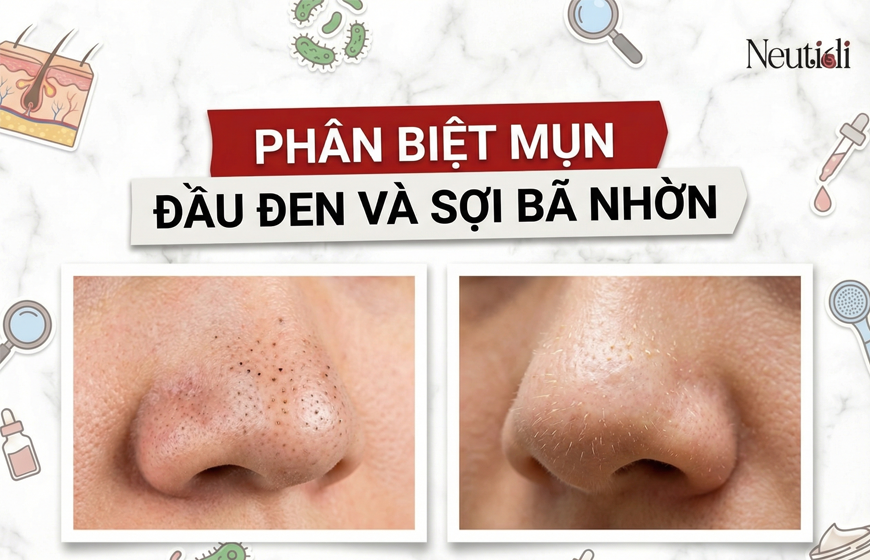 Phân biệt mụn đầu đen và sợi bã nhờn