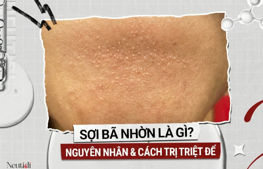 Sợi bã nhờn là gì? Cách trị ra sao