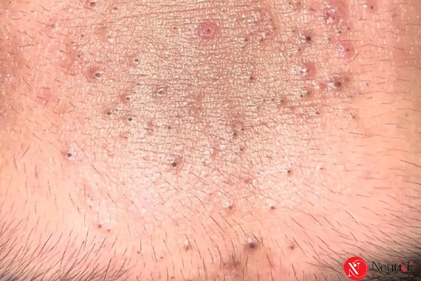 7 nguyên nhân mụn đầu đen ở trán + cách trị dứt điểm hiệu quả 3 Tại sao vùng trán dễ bị mụn đầu đen hơn?