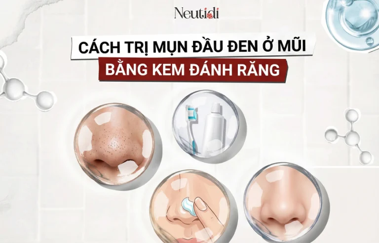 Trị mụn đầu đen ở mũi bằng kem đánh răng