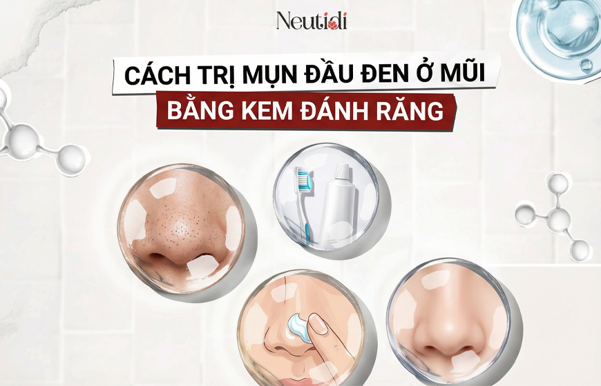 Trị mụn đầu đen ở mũi bằng kem đánh răng có hiệu quả? Thực hiện ra sao? 1 Trị mụn đầu đen ở mũi bằng kem đánh răng