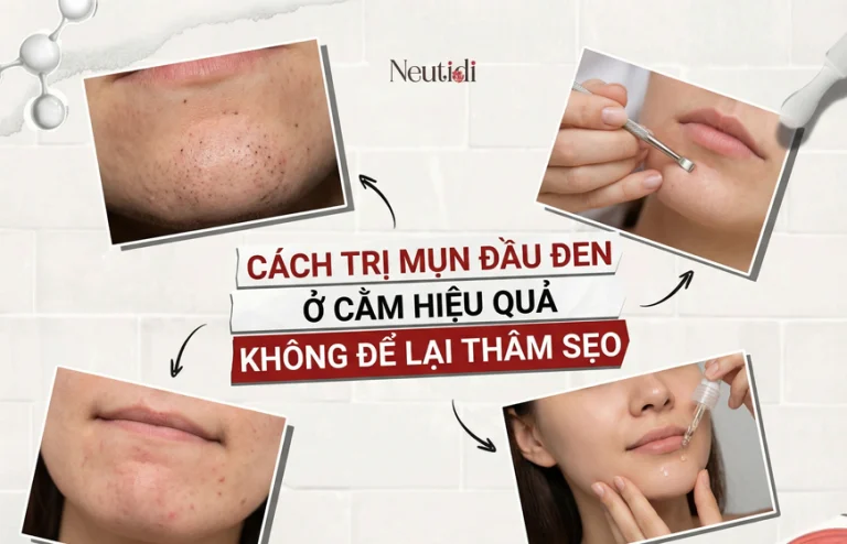 Trị mụn đầu đen ở cằm