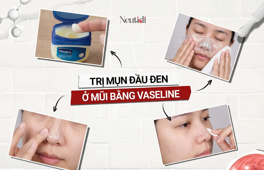 Trị mụn đầu đen ở mũi bằng Vaseline: Có hiệu quả không? 5 bước dùng đúng 1 Trị mụn đầu đen ở mũi bằng vaseline