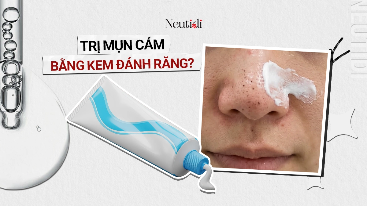 Cách trị mụn cám bằng kem đánh răng