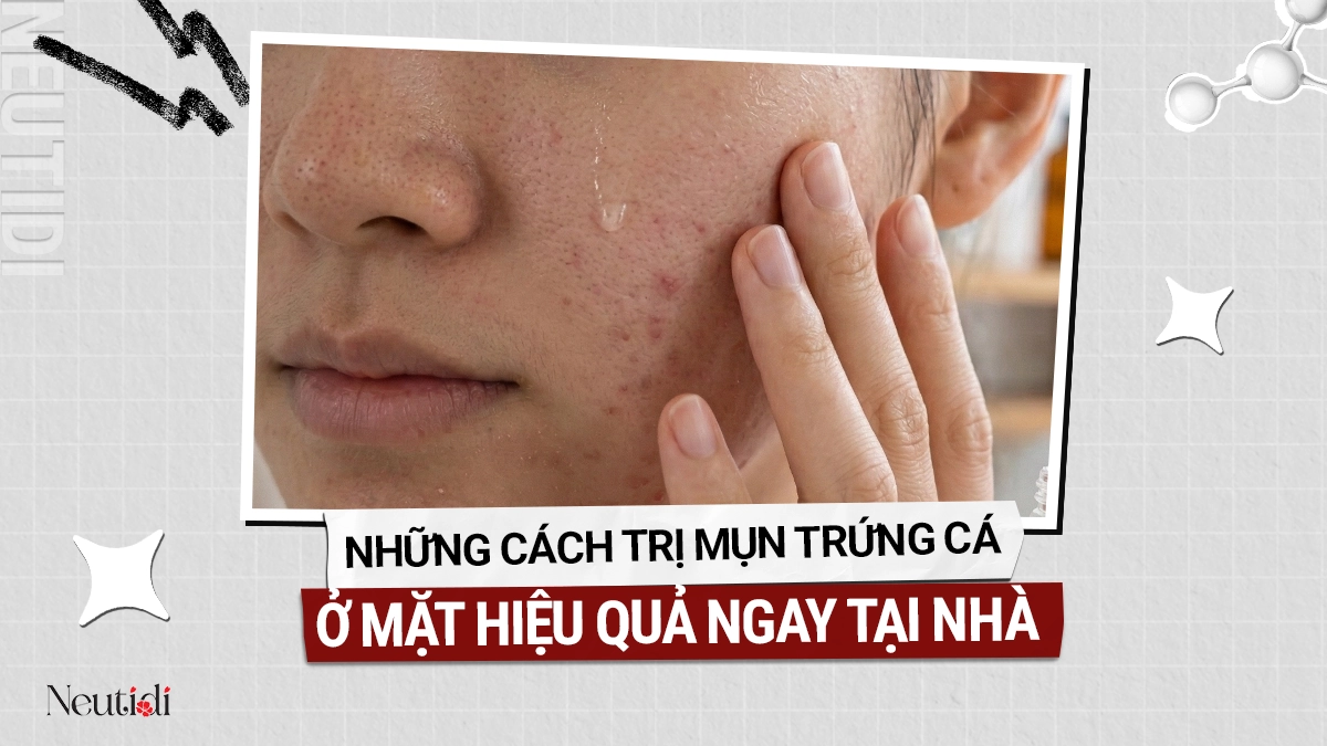 Cách trị mụn trứng cá hiệu quả tại nhà