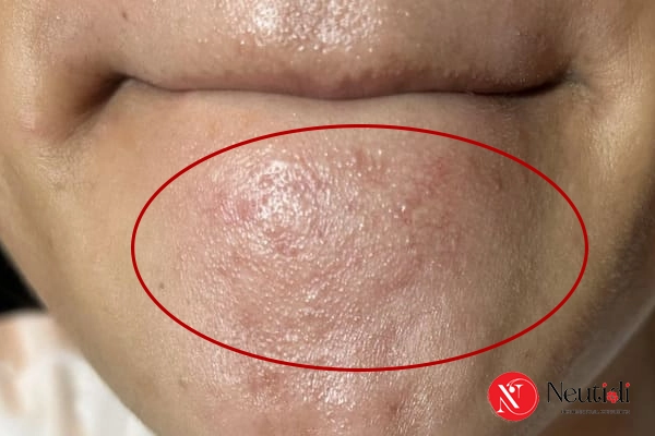 Mụn cám ở cằm: Nguyên nhân & 7 cách trị hiệu quả tại nhà 10 Mụn cám ở cằm có tự hết được không?