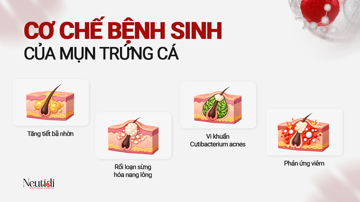 Cơ chế bệnh sinh của mụn trứng cá là gì? 5 Cơ chế bệnh sinh của mụn trứng cá