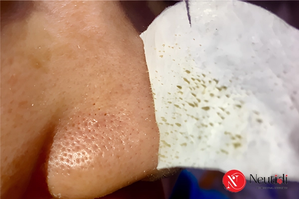 Có nên dùng mặt nạ lột mụn cám không? 5 tác hại và cách thay thế an toàn 2 Có nên lột mun cám hay không? Chuyên gia giải đáp