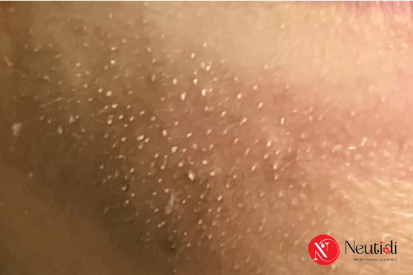 Vậy khi nào nên nặn mụn cám?