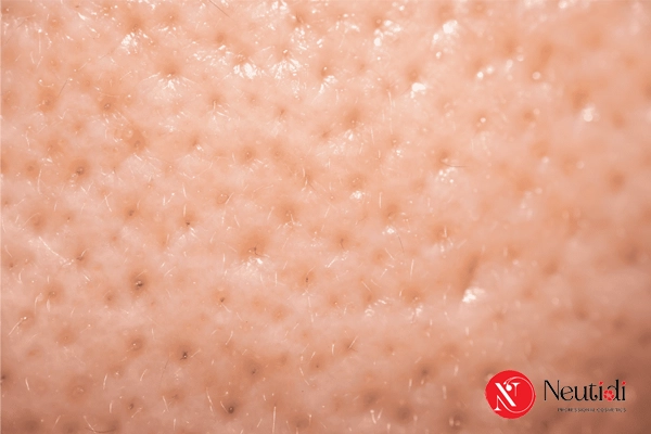 Có nên dùng mặt nạ lột mụn cám không? 5 tác hại và cách thay thế an toàn 3 Lột mụn cám nhiều khiến lỗ chân lông giãn nở vĩnh viễn