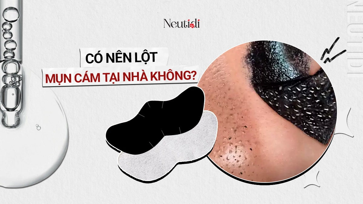 Có nên dùng mặt nạ lột mụn cám không? 5 tác hại và cách thay thế an toàn 1 Lột mụn cám tại nhà