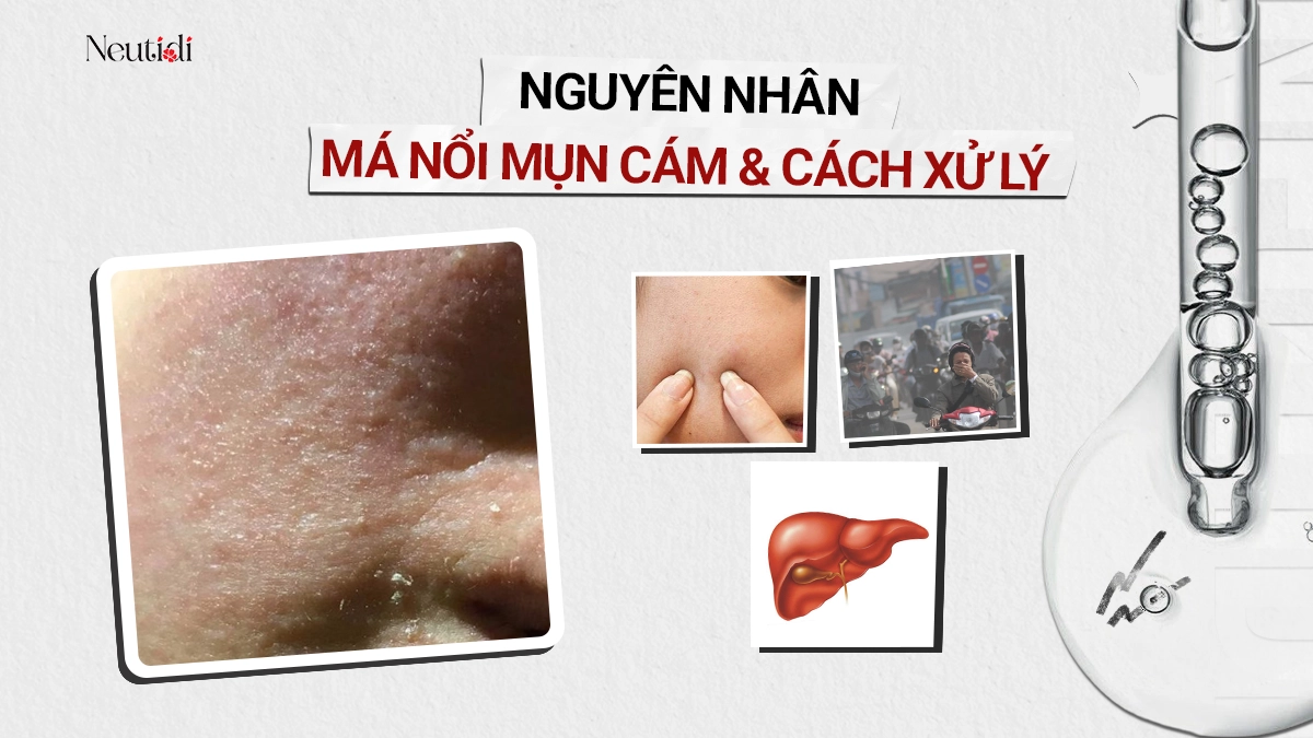 Má nổi mụn cám