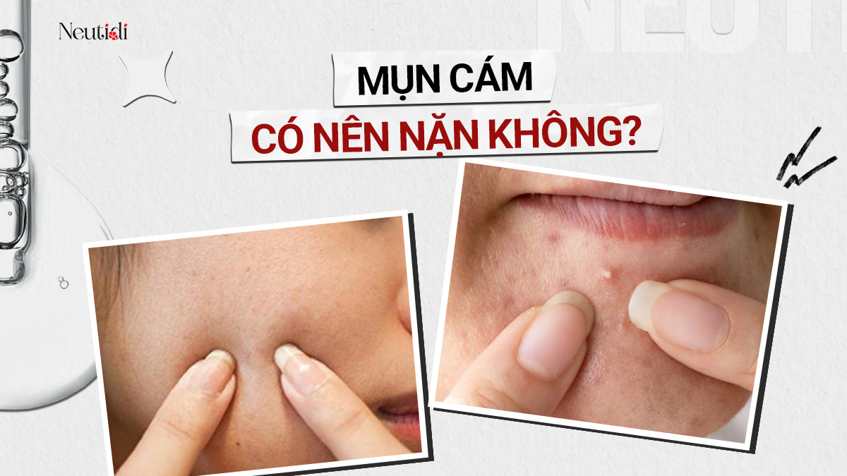 Mụn cám có nên nặn không?