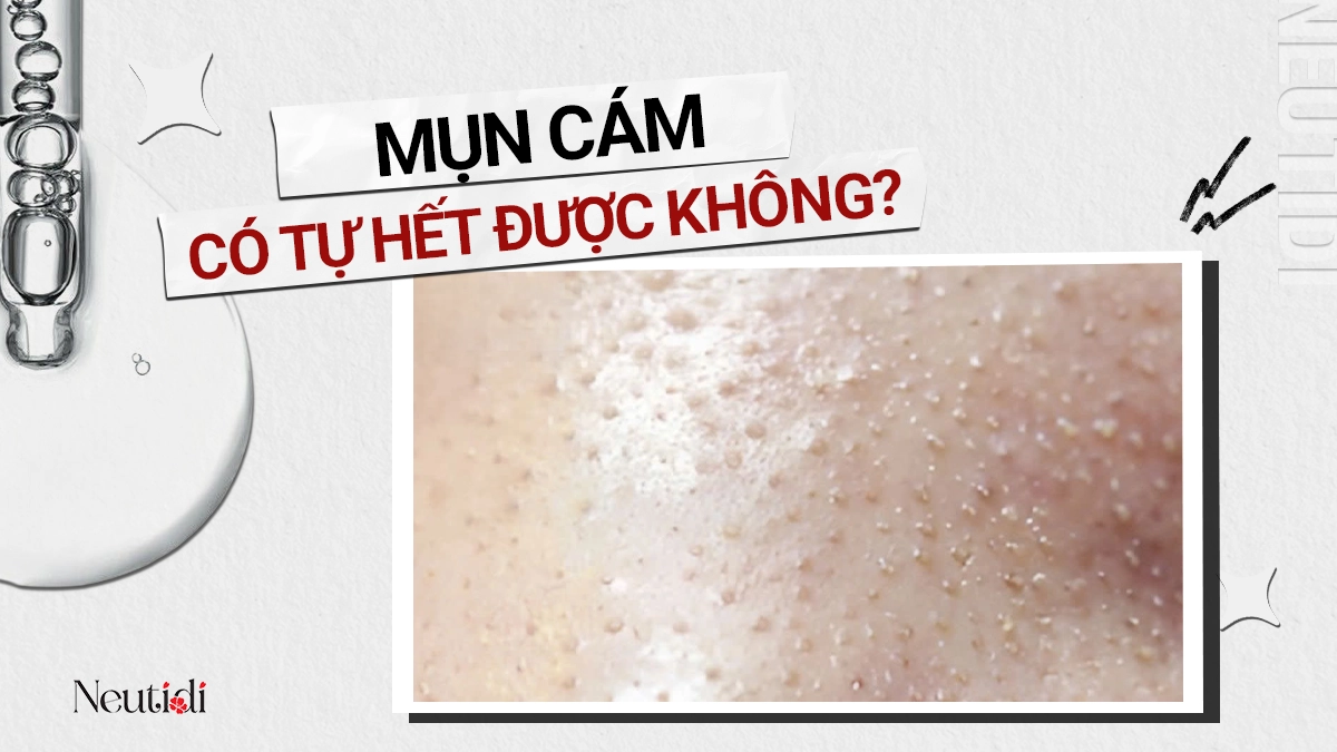 Mụn cám có tự hết được không?