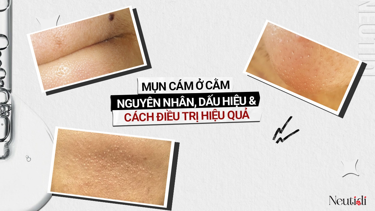 Mụn cám ở cằm: Nguyên nhân & 7 cách trị hiệu quả tại nhà 1 Mụn cám ở cằm: Nguyên nhân & Cách điều trị hiệu quả