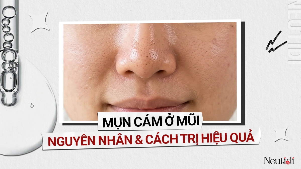 Mụn cám ở mũi là gì?
