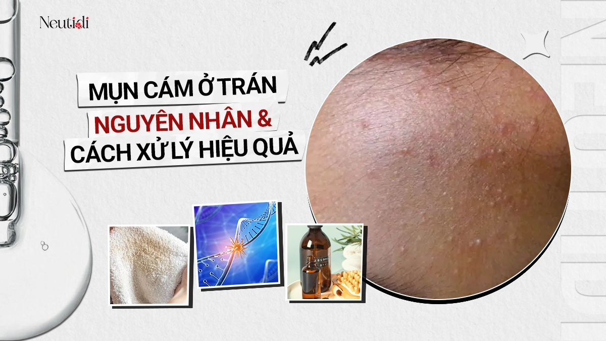 Mụn cám ở trán: Nguyên nhân, dấu hiệu và cách xử lý