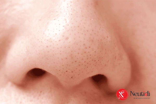 Có nên dùng mặt nạ lột mụn cám không? 5 tác hại và cách thay thế an toàn 4 Mụn cám tái phát nhiều hơn trước