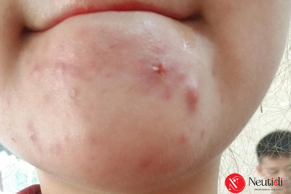 Mụn trứng cá ở cằm: Nguyên nhân, dấu hiệu và cách điều trị dứt điểm 2 Mụn trứng cá ở cằm