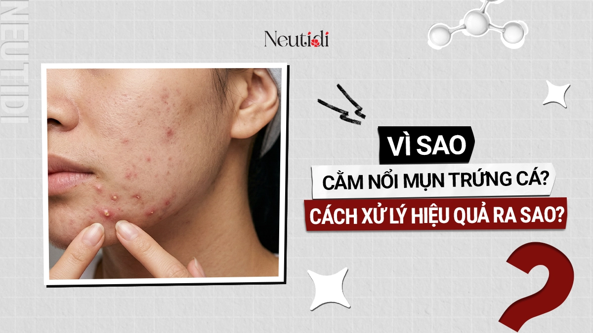 Mụn trứng cá ở cằm: Nguyên nhân, dấu hiệu và cách điều trị dứt điểm 1 Nổi mụn trứng cá ở cằm