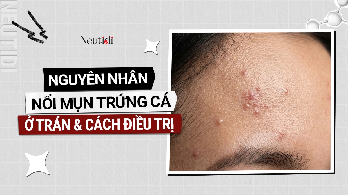 Mụn trứng cá ở trán: Nguyên nhân, phân loại & cách trị hiệu quả