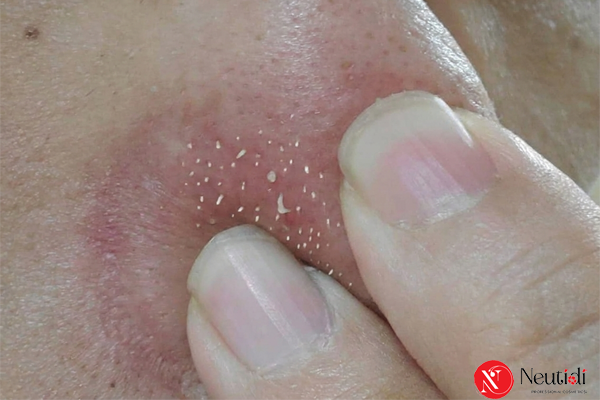 Có nên nặn sợi bã nhờn? Hậu quả & cách xử lý an toàn hơn 2 Không nên nặn sợi bã nhờn