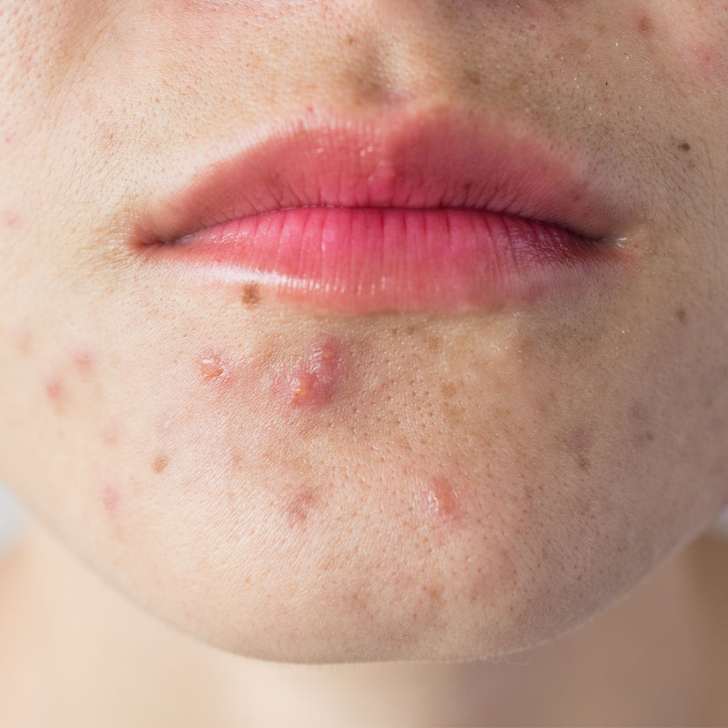 Nhn din tnh trng da mn cng Neutidi