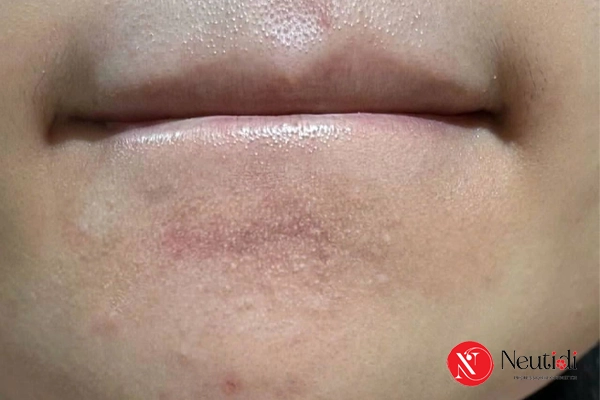 Mụn cám ở cằm: Nguyên nhân & 7 cách trị hiệu quả tại nhà 3 Nguyên nhân gây nổi mụn cám nhiều ở cằm