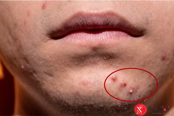 Mụn trứng cá ở cằm: Nguyên nhân, dấu hiệu và cách điều trị dứt điểm 3 Rối loạn nội tiết tố là nguyên nhân gây mụn trứng cá ở cằm phổ biến nhất