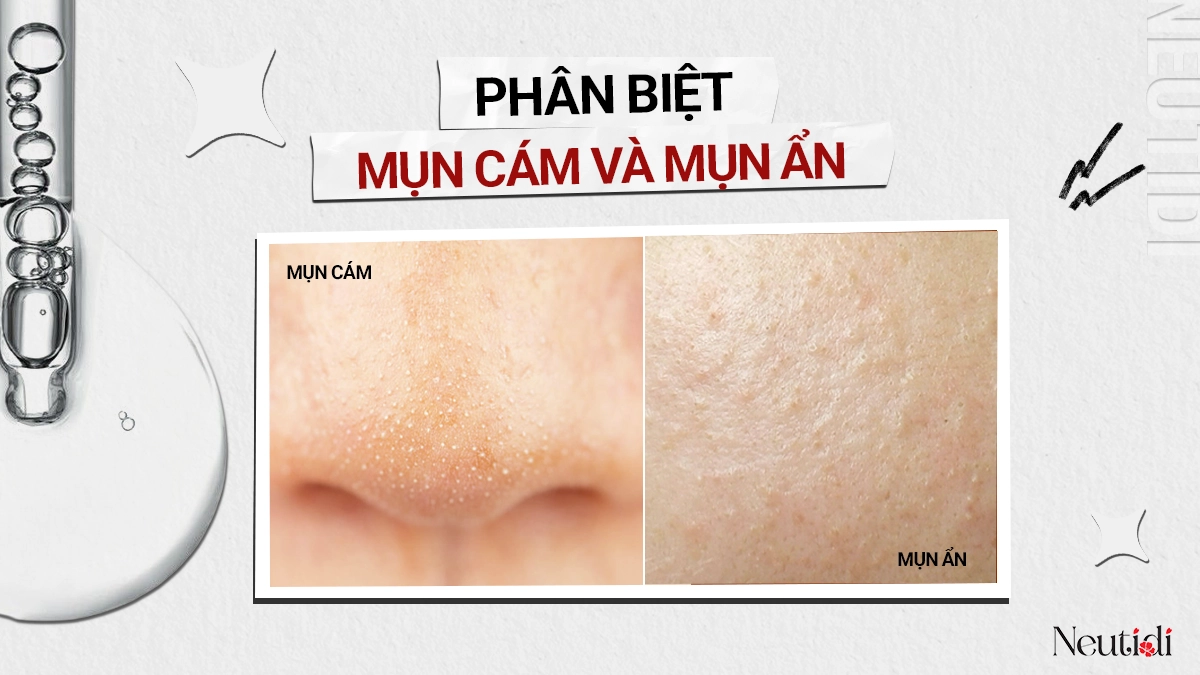 Phân biệt mụn cám và mụn ẩn