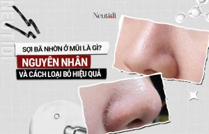 Sợi bã nhờn ở mũi là gì