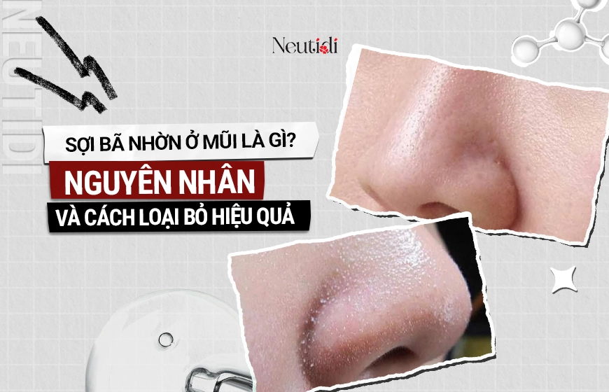 Sợi bã nhờn ở mũi là gì