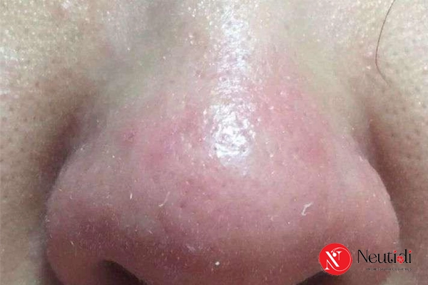 Tại sao không nên nặn mụn cám?