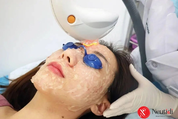 Mụn trứng cá ở cằm: Nguyên nhân, dấu hiệu và cách điều trị dứt điểm 6 Trị mụn trứng cá bằng công nghệ y khoa