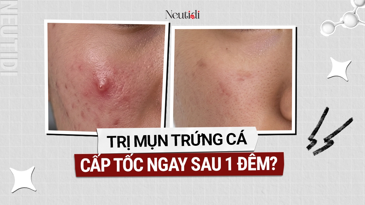 Cách Trị mụn trứng cá cấp tốc sau 1 đêm