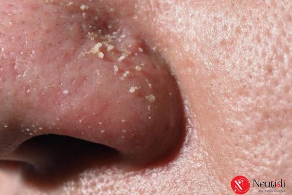 Có nên nặn sợi bã nhờn? Hậu quả & cách xử lý an toàn hơn 3 Trường hợp ngoại lệ có thể nặn sợi bã nhờn