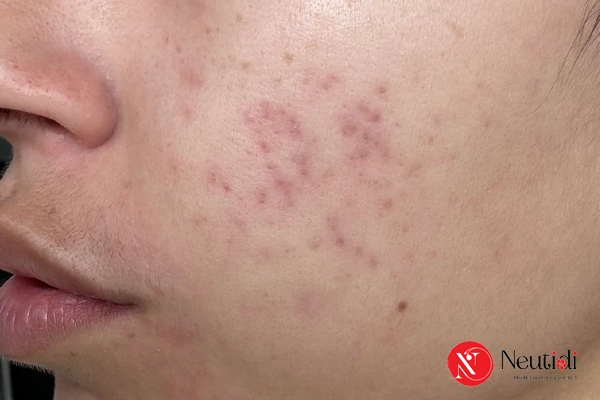 Biểu hiện của thâm đen sau mụn