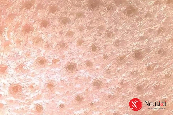 Các loại mụn do bít tắc lỗ chân lông