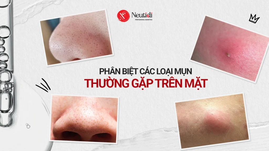 Phân biệt 10 loại mụn trên mặt theo chuẩn y khoa 1 Các loại mụn trên mặt thường gặp