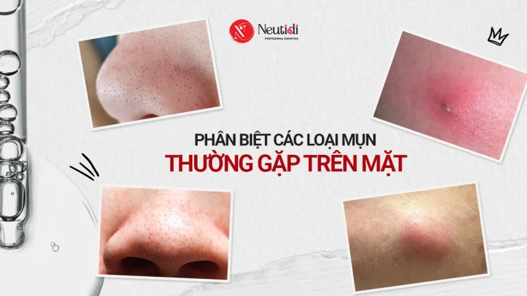 Các loại mụn trên mặt thường gặp