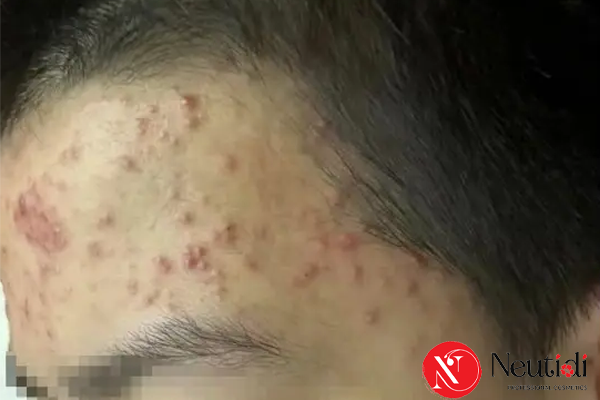 Mụn bùng phát ở tuổi dậy thì - dạng mụn viêm