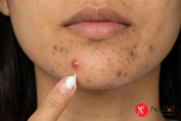 Điều trị thâm sau mụn bằng hoạt chất kem bôi
