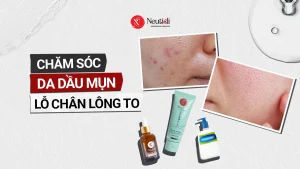 Chăm sóc da dầu mụn lỗ chân lông to