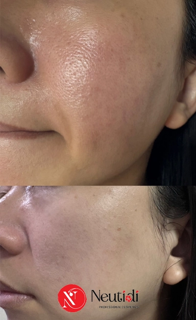 Chăm sóc da dầu mụn lỗ chân lông to với lỗ chân lông to 