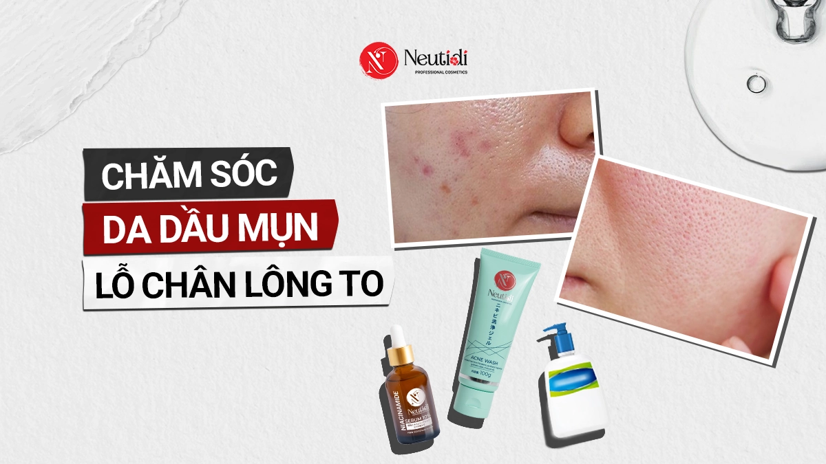 Chăm sóc da dầu mụn lỗ chân lông to