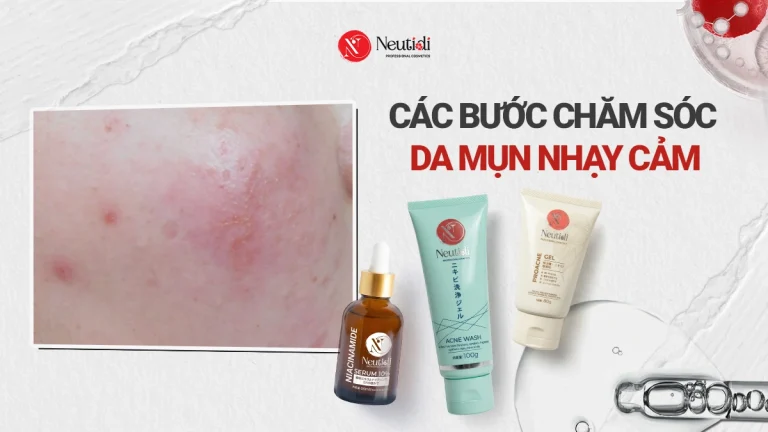 Routine skincare cho da mụn nhạy cảm