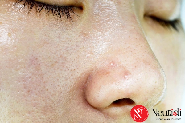 Da dầu mụn lỗ chân lông to