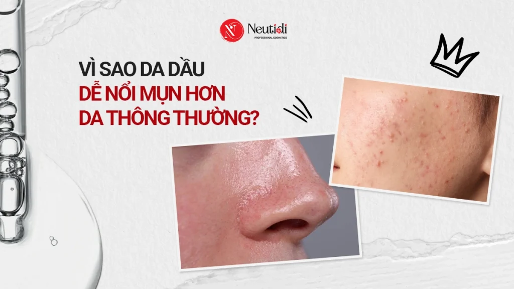Vì sao da dầu dễ nổi mụn hơn da thông thường?